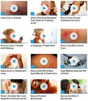How to Get Rid of Acne