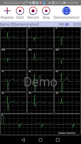 aECG