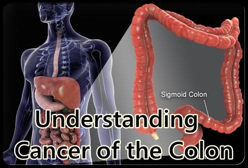 Understanding Cancer of Colon