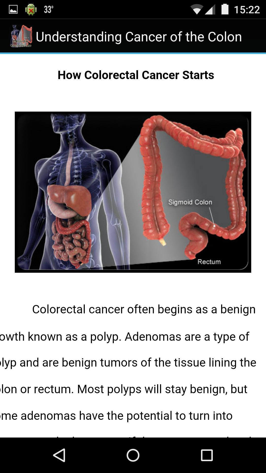 Understanding Cancer of Colon