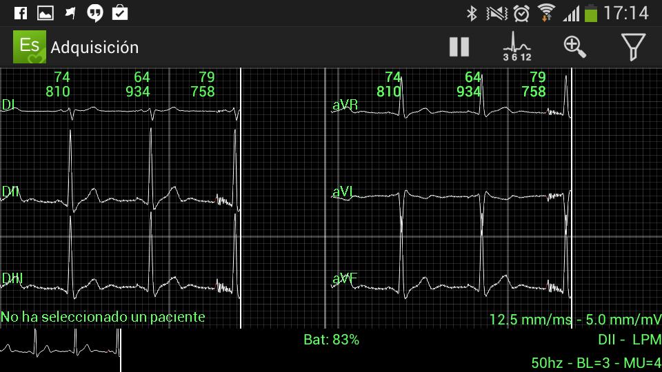 ElectroSmart ECG