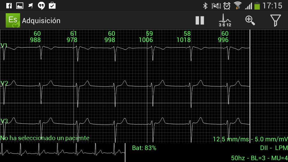 ElectroSmart ECG