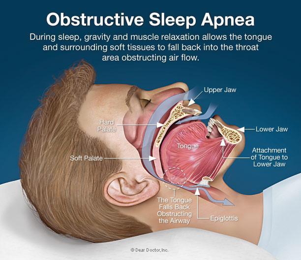 Sleep Apnea Treatment