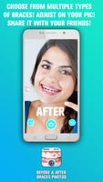 Before and After braces Photo